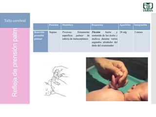 Reflejadeprensiónpalmar
Tallo cerebral
Posición Maniobra Respuesta Aparición Integración
Reacción
prensión
palmar
Supino Presiona firmamente
superficie palmar de
cabeza de metacarpianos
Flexión fuerte y
sostenida de los dedos y
muñeca durante varios
segundos alrededor del
dedo del examinador
28 sdg 3 meses
 