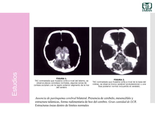 Estudios
Ausencia de parénquima cerebral bilateral. Presencia de cerebelo, mesencéfalo y
estructura talámicas, forma rudimentaria de hoz del cerebro. Gran cantidad de LCR.
Estructuras óseas dentro de límites normales
 