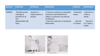 REFLEJO POSICIÓN ESTÍMULO RESPUESTA APARECE DESAPARECE
LANDAU Decúbito prono,
sostenga al
paciente en el
aire,
deteniéndolo del
tórax.
Levantar la
cabeza (activo o
pasivo).
+ Columna y piernas se extienden
(cuando se ventroflexiona la
cabeza, la columna y las piernas
se flexionan.
- Columna y piernas se mantienen
flexionadas.
+ Normal 6
meses
- Normal
< 6 meses
+ Normal 2 o
2 años y
medio
- Normal >
2 o 2 años y
medio
 