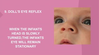 9. DOLL'S EYE REFLEX
WHEN THE INFANTS
HEAD IS SLOWLY
TURNED,THE INFANTS
EYE WILL REMAIN
STATIONARY
 