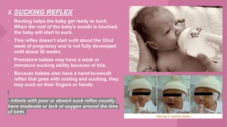 2. SUCKING REFLEX
• Rooting helps the baby get ready to suck.
When the roof of the baby's mouth is touched,
the baby will start to suck.
• This reflex doesn't start until about the 32nd
week of pregnancy and is not fully developed
until about 36 weeks.
• Premature babies may have a weak or
immature sucking ability because of this.
• Because babies also have a hand-to-mouth
reflex that goes with rooting and sucking, they
may suck on their fingers or hands.
- infants with poor or absent suck reflex usually
have moderate or lack of oxygen around the time
of birth.
 