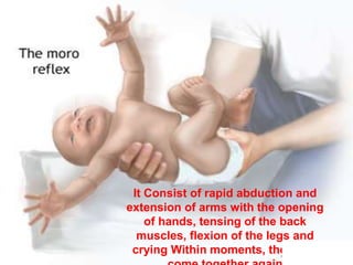 It Consist of rapid abduction and
extension of arms with the opening
of hands, tensing of the back
muscles, flexion of the legs and
crying Within moments, the arms
 