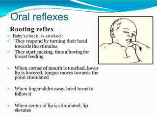 Neurological Examination: Neonatal and Infant Reflexes (NPT) Lecture 3 ...
