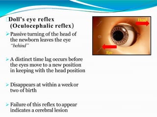 Doll’s eye reflex
(Oculocephalic reflex)
Passive turning of the head of
the newborn leaves the eye
“behind”
 A distinct time lag occurs before
the eyes move to a new position
in keeping with the head position
 Disappears at within a weekor
two of birth
 Failure of this reflex to appear
indicates a cerebral lesion
Head
Eye
 
