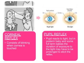 CORNEAL
REFLEX
• Consists of blinking
when cornea is
touched
PUPIL REFLEX
• Pupil reacts to light, but in
preterm baby and some
full term babies the
duration of exposure to
the light may have to be
prolonged to elicit the
reflex.
 