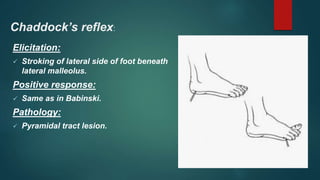 Chaddock’s reflex:
Elicitation:
 Stroking of lateral side of foot beneath
lateral malleolus.
Positive response:
 Same as in Babinski.
Pathology:
 Pyramidal tract lesion.
 