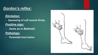 Gordon’s reflex:
Elicitation:
 Squeezing of calf muscle firmly.
Positive sign:
 Same as in Babinski.
Pathology:
 Pyramidal tract lesion.
 