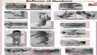 Comprehensive Overview of Newborn Reflexes and Their Developmental ...