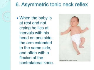 6. Asymmetric tonic neck reflex
 When the baby is
at rest and not
crying he lies at
inervals with his
head on one side,
the arm extended
to the same side,
and often with a
flexion of the
contralateral knee.
 