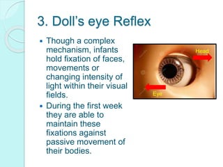 3. Doll’s eye Reflex
 Though a complex
mechanism, infants
hold fixation of faces,
movements or
changing intensity of
light within their visual
fields.
 During the first week
they are able to
maintain these
fixations against
passive movement of
their bodies.
Eye
Head
 