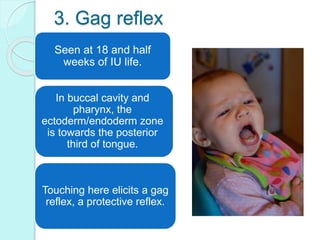3. Gag reflex
In buccal cavity and
pharynx, the
ectoderm/endoderm zone
is towards the posterior
third of tongue.
Seen at 18 and half
weeks of IU life.
Touching here elicits a gag
reflex, a protective reflex.
 