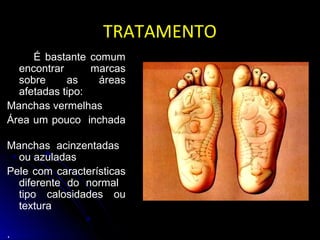TRATAMENTOTRATAMENTO
É bastante comum
encontrar marcas
sobre as áreas
afetadas tipo:
Manchas vermelhas
Área um pouco inchada
Manchas acinzentadas
ou azuladas
Pele com características
diferente do normal
tipo calosidades ou
textura
.
 