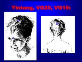 Yintang, VG20, VG19:
 