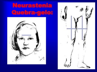 Neurastenia
Quebra-gelo:
 