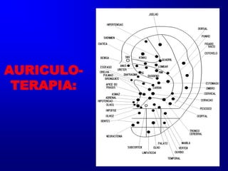 AURICULO-
TERAPIA:
 