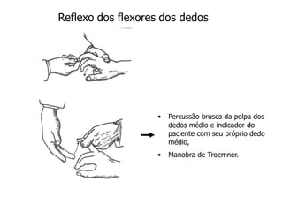 Reflexo dos flexores dos dedos
• Percussão brusca da polpa dos
dedos médio e indicador do
paciente com seu próprio dedo
médio,
• Manobra de Troemner.
 