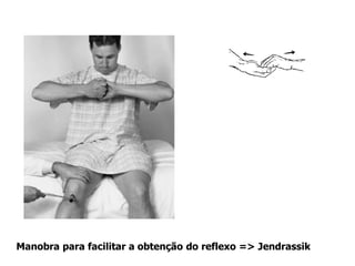 Manobra para facilitar a obtenção do reflexo => Jendrassik
 