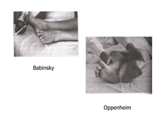 Babinsky
Oppenheim
 