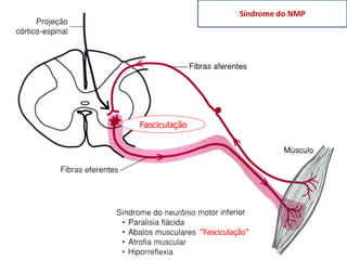 “Fasciculação”
Fasciculação
Síndrome do NMP
 