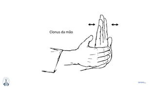 42MFMM
Clonus da mão
 