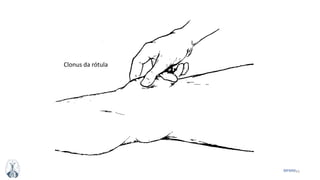 43MFMM
Clonus da rótula
 