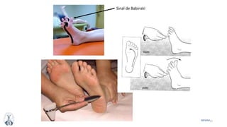 52MFMM
Sinal de Babinski
 