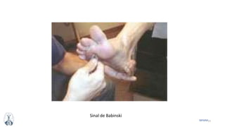 53MFMM
Sinal de Babinski
 