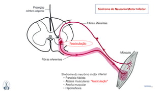 63MFMM
“Fasciculação”
Fasciculação
Síndrome do Neuronio Motor Inferior
 