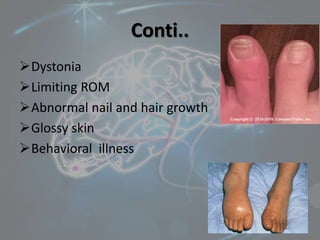 Conti..
Dystonia
Limiting ROM
Abnormal nail and hair growth
Glossy skin
Behavioral illness
 