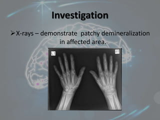Investigation
X-rays – demonstrate patchy demineralization
in affected area.
 