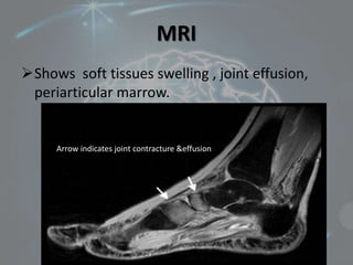 MRI
Shows soft tissues swelling , joint effusion,
periarticular marrow.
Arrow indicates joint contracture &effusion
 