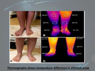 Thermography shows temperature difference in affected areas
 