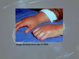 Image showing mirror pain in CRPS
 