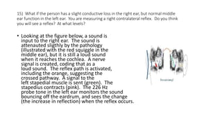 15) What if the person has a slight conductive loss in the right ear, but normal middle
ear function in the left ear. You are measuring a right contralateral reflex. Do you think
you will see a reflex? At what levels?
• Looking at the figure below, a sound is
input to the right ear. The sound is
attenauted sligthly by the pathology
(illustrated with the red squiggle in the
middle ear), but it is still a loud sound
when it reaches the cochlea. A nerve
signal is created, coding that as a
loud sound. The reflex path is activated,
including the orange, suggesting the
crossed pathway. A signal to the
left stapedial muscle is sent (green). The
stapedius contracts (pink). The 226 Hz
probe tone in the left ear monitors the sound
bouncing off the eardrum, and sees the change
(the increase in reflection) when the reflex occurs.
 