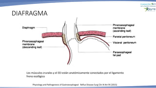 DIAFRAGMA
Physiology and Pathogenesis of Gastroesophageal Reflux Disease Surg Clin N Am 95 (2015)
Los músculos crurales y el EEI están anatómicamente conectados por el ligamento
freno esofágico
 