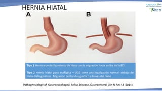 HERNIA HIATAL
Pathophysiology of Gastroesophageal Reflux Disease, Gastroenterol Clin N Am 43 (2014)
Tipo 1 Hernia con deslizamiento de hiato con la migración hacia arriba de la EEI.
Tipo 2 Hernia hiatal para esofágica – UGE tiene una localización normal- debajo del
hiato diafragmático . Migración del fundus gástrico a través del hiato
 
