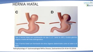 HERNIA HIATAL
Pathophysiology of Gastroesophageal Reflux Disease, Gastroenterol Clin N Am 43 (2014)
Tipo 3 hernia hiatal con combinación de tipo 1 y 2 tanto la UGE y fundus gástrico
migran a través del hiato diafragmático.
Tipo 4 hernia hiatal con herniación de otros órganos abdominales como el colon o el
bazo
 