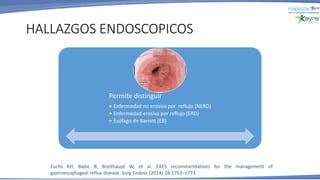 Permite distinguir
• Enfermedad no erosiva por reflujo (NERD)
• Enfermedad erosiva por reflujo (ERD)
• Esófago de Barrett (EB)
HALLAZGOS ENDOSCOPICOS
Fuchs KH, Babic B, Breithaupt W, et al. EAES recommendations for the management of
gastroesophageal reflux disease. Surg Endosc (2014) 28:1753–1773
 