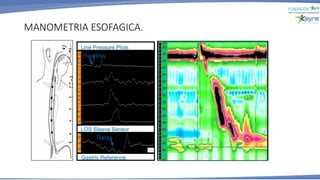 MANOMETRIA ESOFAGICA.
 