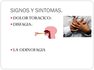 SIGNOS Y SINTOMAS.
 DOLORTORACICO:
 DISFAGIA:
 LA ODINOFAGIA
 