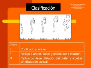 Clasificación SOCIEDAD COLOMBIANA DE UROLOGÍA GUÍAS DE PRÁCTICA CLÍNICA (GPC) Reflujo con leve dilatación del uréter y la pelvis sin dilatación calicial. III Reflujo a uréter, pelvis y cálices sin dilatación. II Confinado al uréter I Grado 