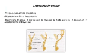 Trabeculación vesical
-Vejiga neurogénica espástica
-Obstrucción distal importante
-Hipertrofia trigonal  protrusión de mucosa de hiato ureteral  dilatación 
acortamiento intravesical
 