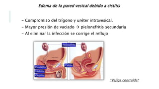 Edema de la pared vesical debido a cistitis
- Compromiso del trígono y uréter intravesical.
- Mayor presión de vaciado  pielonefritis secundaria
- Al eliminar la infección se corrige el reflujo
*Vejiga contraída*
 