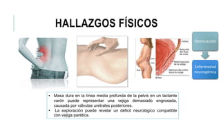 HALLAZGOS FÍSICOS
Obstrucción
Enfermedad
neurogénica
• Masa dura en la línea media profunda de la pelvis en un lactante
varón puede representar una vejiga demasiado engrosada,
causada por válvulas uretrales posteriores.
• La exploración puede revelar un déficit neurológico compatible
con vejiga parética.
 