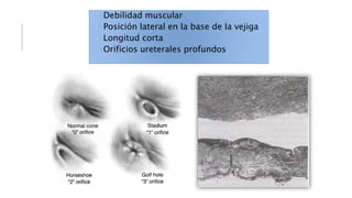  Debilidad muscular
 Posición lateral en la base de la vejiga
 Longitud corta
 Orificios ureterales profundos
 