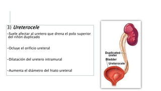 3) Ureterocele
-Suele afectar al uretero que drena el polo superior
del riñón duplicado
-Ocluye el orificio ureteral
-Dilatación del uretero intramural
-Aumenta el diámetro del hiato ureteral
 