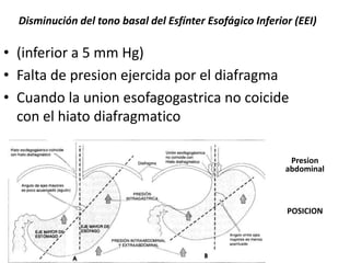 Disminución del tono basal del Esfínter Esofágico Inferior (EEI)

• (inferior a 5 mm Hg)
• Falta de presion ejercida por el diafragma
• Cuando la union esofagogastrica no coicide
  con el hiato diafragmatico

                                                            Presion
                                                           abdominal



                                                           POSICION
 