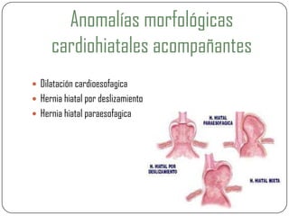 Anomalías morfológicas
cardiohiatales acompañantes
 Dilatación cardioesofagica
 Hernia hiatal por deslizamiento
 Hernia hiatal paraesofagica
 