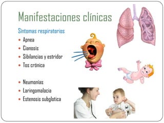 Manifestaciones clínicas
Síntomas respiratorios
 Apnea
 Cianosis
 Sibilancias y estridor
 Tos crónica
 Neumonías
 Laringomalacia
 Estenosis subglotica
 
