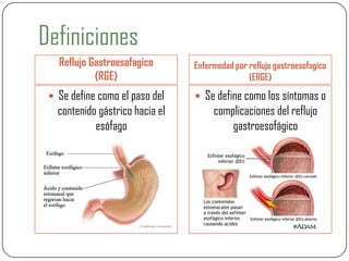 Definiciones
Reflujo Gastroesofagico
(RGE)
Enfermedad por reflujo gastroesofagico
(ERGE)
 Se define como el paso del
contenido gástrico hacia el
esófago
 Se define como los síntomas o
complicaciones del reflujo
gastroesofágico
 